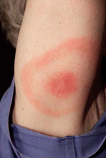 Erythema Migrans, also known as the "Bull's Eye Wound"