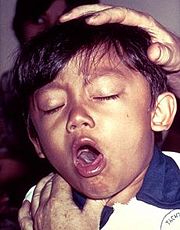 A young boy coughing due to pertussis.