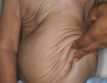 Child with congenital cutis laxa. The skin appears loose and wrinkly