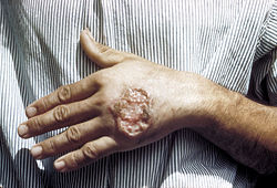 Skin ulcer due to leishmaniasis, hand of Central American adult