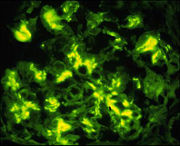 Immunofluorescence detecting IgA in IgA glomerulonephritis. From , with permission