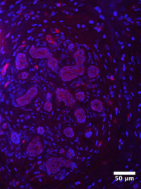 Fig. 2: Beta1 integrin expression in a human breast tumor stained in the Peyton Lab. Beta1 integrin (red) is expressed in the tumor cells. DAPI stains the nuclei in blue.