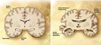 Comparison of Normal Brain (Left) & Brain with Alzheimer's (Right)